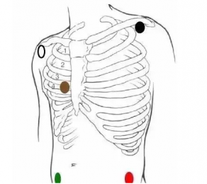 心電監護5個電極位置圖，電極片放置位置在哪？