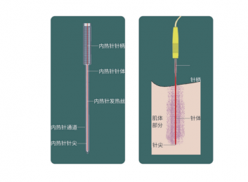 什么是內熱式針灸治療儀?內熱針的作用原理