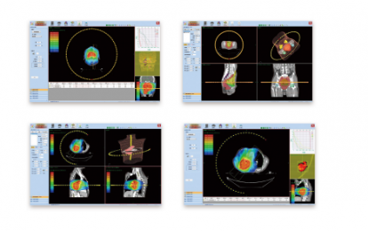 三維放射治療計(jì)劃系統(tǒng)：高精度的圖像