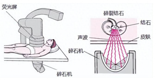 體內(nèi)沖擊波膽道碎石儀操作流程解析