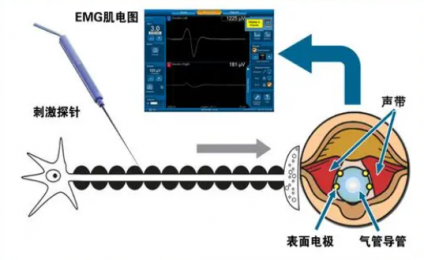 喉返神經監測儀：甲狀腺手術新設備